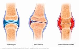 1. porovnanie zdravého kĺbu, osteoartirify a rematodinej artiritidy