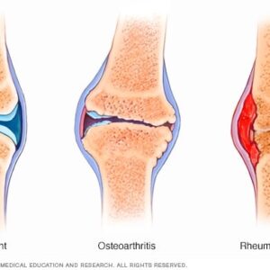 1. porovnanie zdravého kĺbu, osteoartirify a rematodinej artiritidy