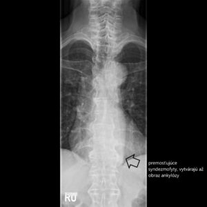 2. TH ankylozujuca spondylitida AP final (2)